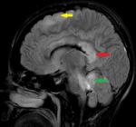 Non-bleeding lesions: Axonal injury to hemisphere (yellow arrow), axonal injury to corpus callosum (red arrow), and axonal injury to the cerebellum and brainstem (green arrow). (Photo: INM/NTNU)