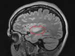 MR of a low-grade glioma in the temple lobe.