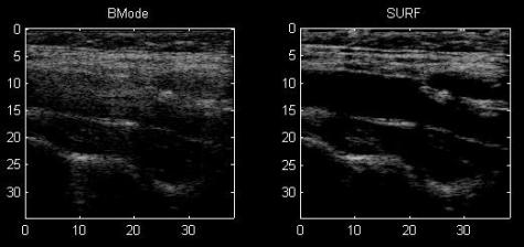 Left image shows an ordinary ultrasound image of the carotid artery bifurcation (neck), where a lot of multiple scattering noise is found in the image.