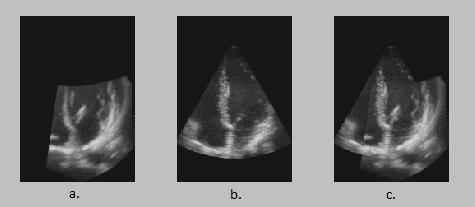 Registration of echocardiographic data acquired from different views (a. parasternal view, b. apical view, c. fused view)