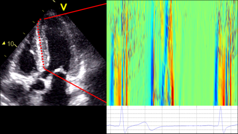 Color M-mode based on tissue Doppler imaging, showing waves of deformation propagating in heart muscle over time (x-axis)