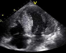 heart with hypertrophy and stiff walls