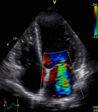 Example of a leakage through the mitral valve, shown using 2D color Doppler
