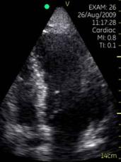 Ultrasound image of the heart