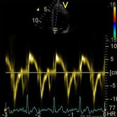 Pulse wave doppler image of the heart