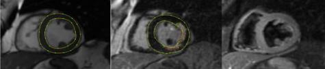 Different acquisitions of the same patient and delineation of the myocardial infarct (red), endo-, epi-cardium (yellow)