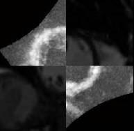 Ultrasound and MR image of the heart