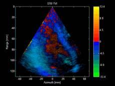 Single Pulse Tissue Doppler