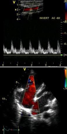 Power doppler (upper panel), Color doppler (lower panel)