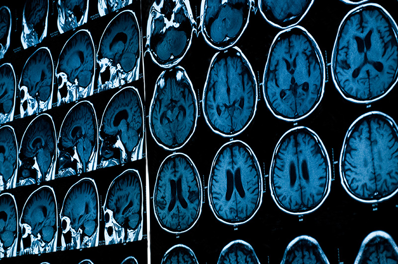 Brain scan images. Photo by Tushchakorn/Shutterstock