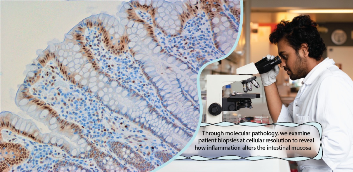 Researcher looking into microscope. Text on photo: Through molecular pathology, we examine patient biopsies at cellular resolution to reveal how inflammation alters the intestinal mucosa.
