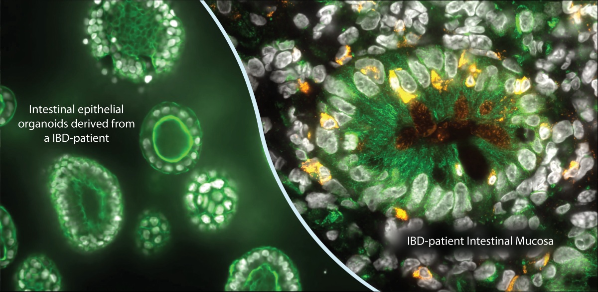 Organoids enlarged. Text on photo: Intestinal epithelial organoids derived from a IBD-patient IBD-patient Intestinal mucosa.