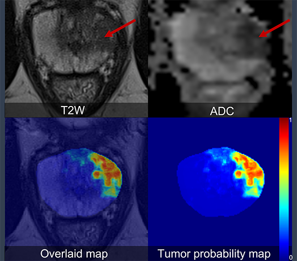 Prostate cancer