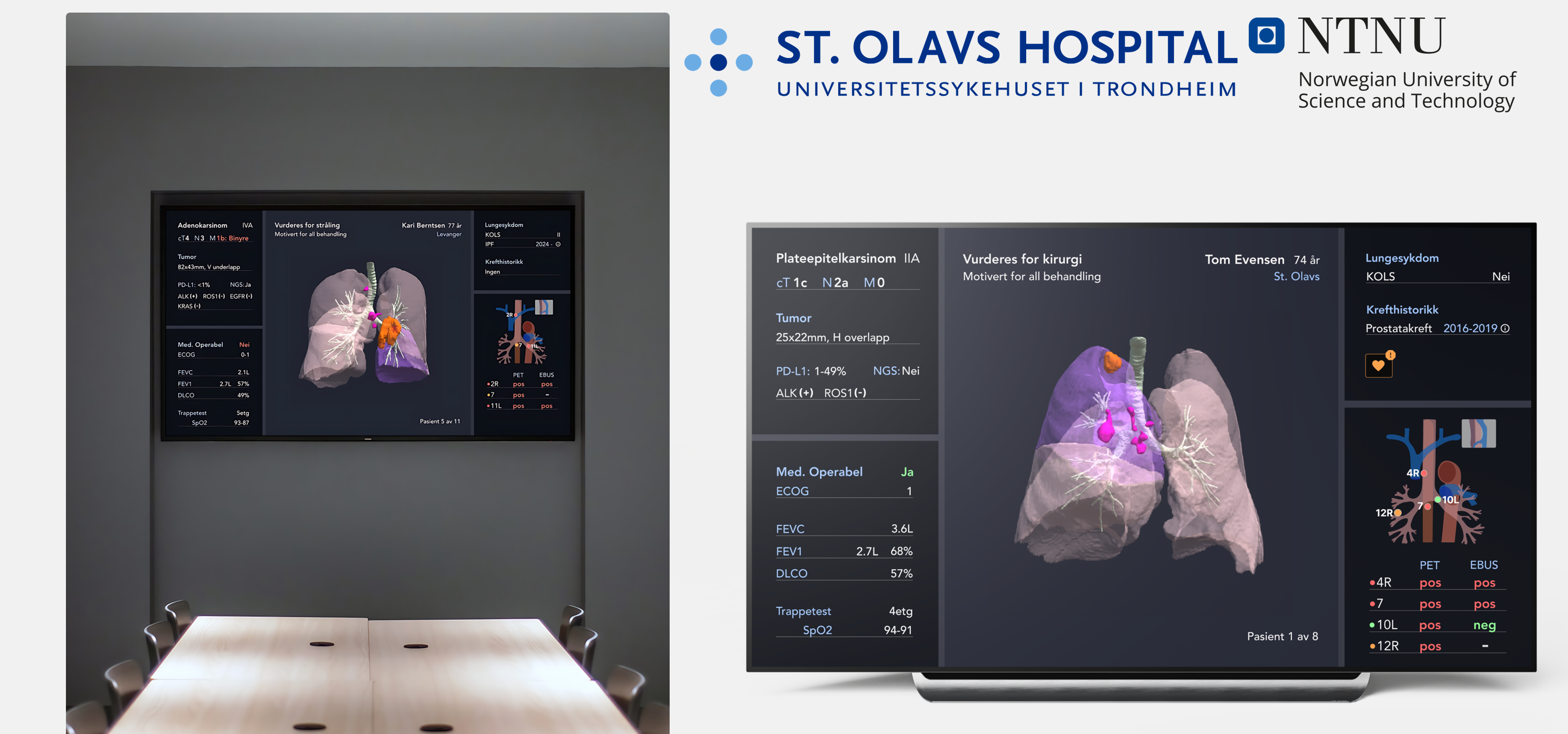 Illustration for Innovative Clinical Decision Support System for Multi-disciplinary Lung Cancer Teams. Illustration from Master thesis by Molly Gibson and Mathilde Wessmann Bogen.