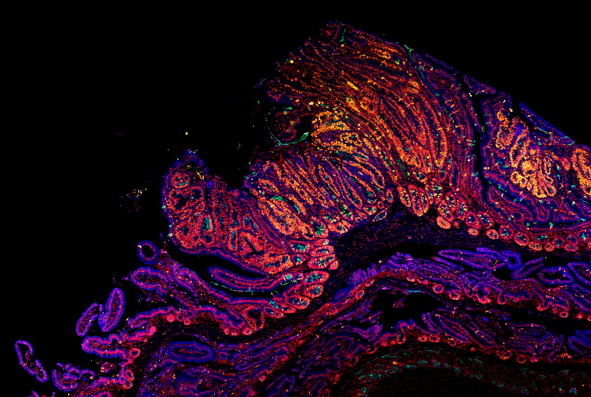 A fluorescent microscope image of an adenoma section from the duodenum of an APC Min/+ mouse.