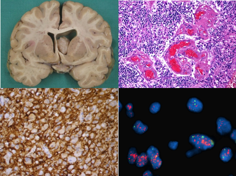 Microscope images of brain tumours