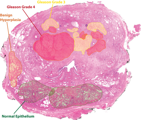 A representative whole-mount prostate tissue slice (hemotoxyllin and eosin stained) which is digitally annotated by an experience pathologist. This is the road map we use to drill specific tissue samples from different areas and cells in the fresh frosen tissue