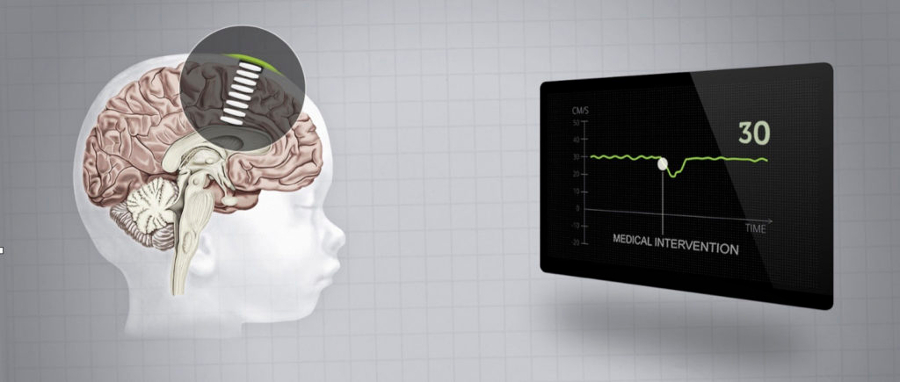 Illustration of brain being scanned by ultrasound.