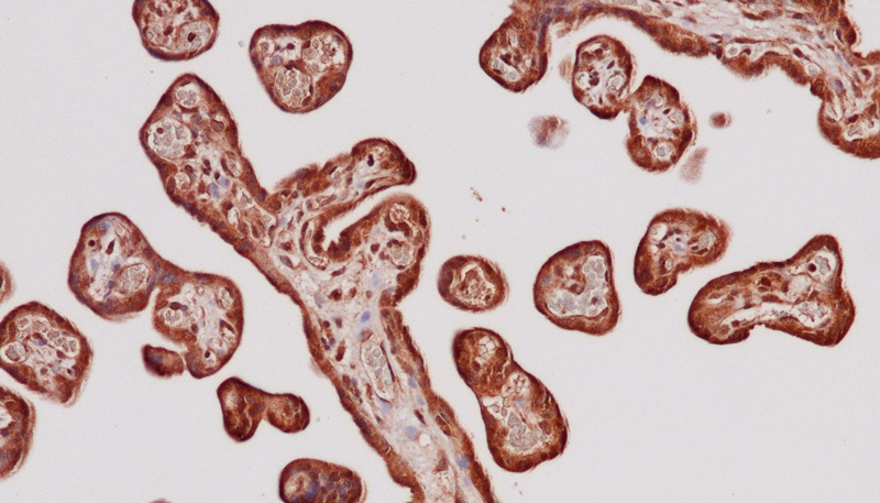 Placenta of a preeclamptic pregnancy. Fetal structures in the placenta  is sourrounded by the specialized syncytium layer protecting fetal cells from maternal blood. The syncytium in preeclampsia strongly express IL-1beta as indicated by positive IHC staining (brown). Photo: Guro Stødle