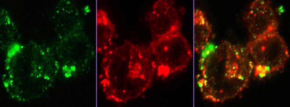 Multiple myeloma cells stained for IL-32 (red) and CD63 (green). Photo: Muhammad Zahoor / NTNU